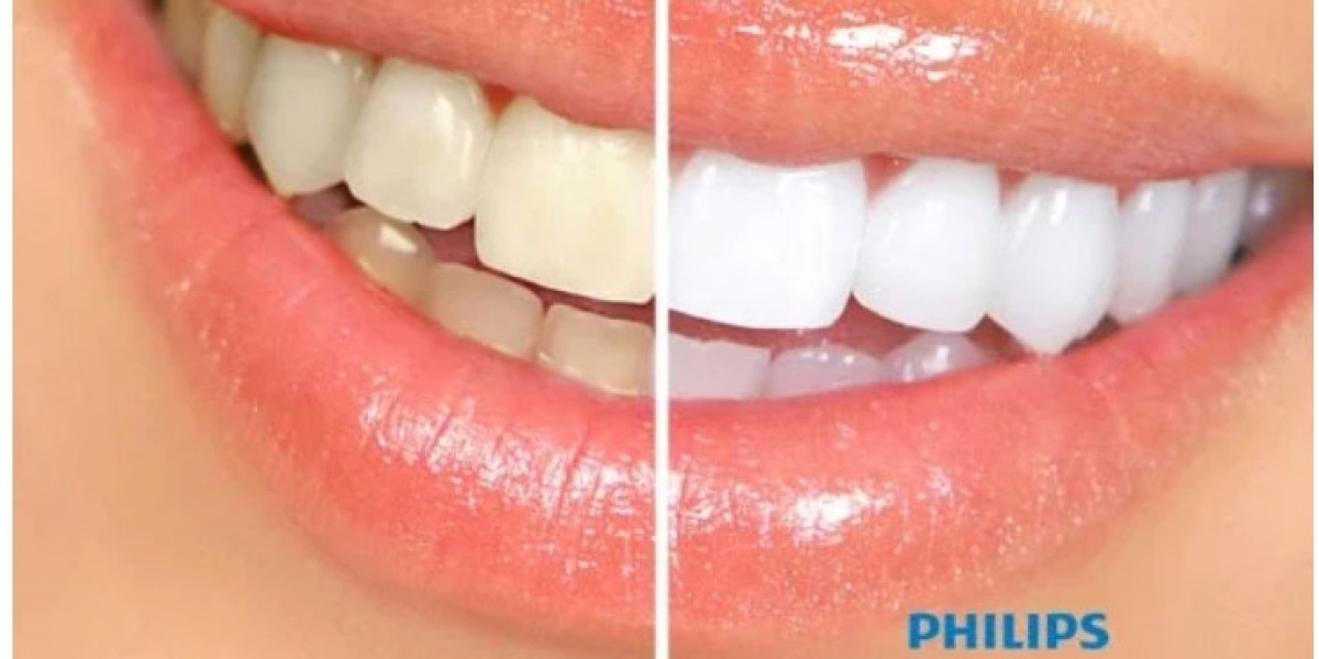 Teeth Whitening Cost in Mumbai: Achieve a Brighter Smile with Dental Opal